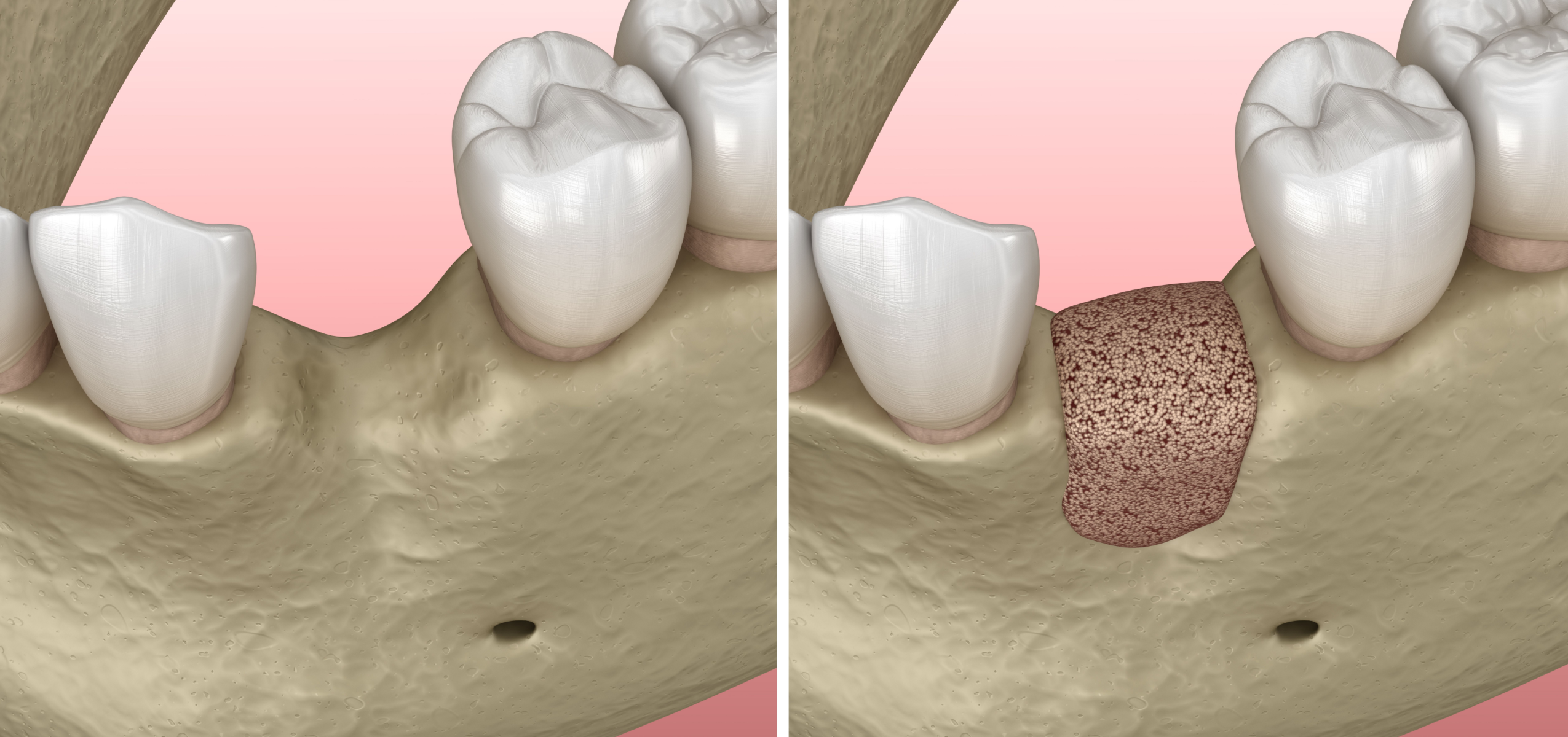 Régénération osseuse